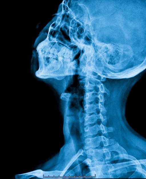 Основные признаки остеопороза на рентгене